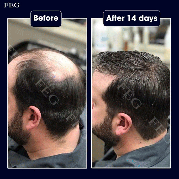 FEG Hair Growth